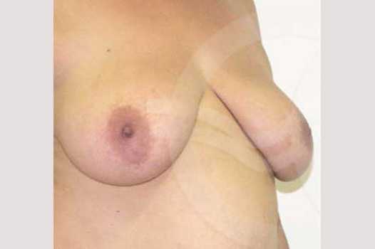 Breast Lift Vertical Incision ante/post-op II