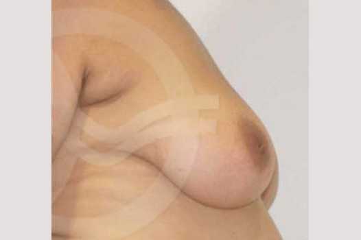 Breast Lift Vertical Incision ante/post-op III