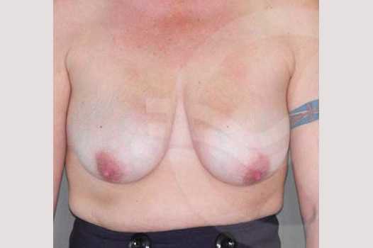 Breast Lift 350cc round implants ante/post-op I