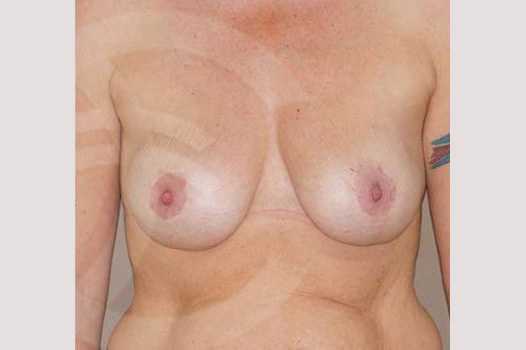 Breast Lift 350cc round implants ante/post-op I