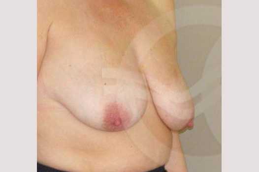 Breast Lift 350cc round implants ante/post-op II