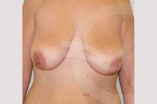 Breast Lift Inverse-T Scar ante/post-op I