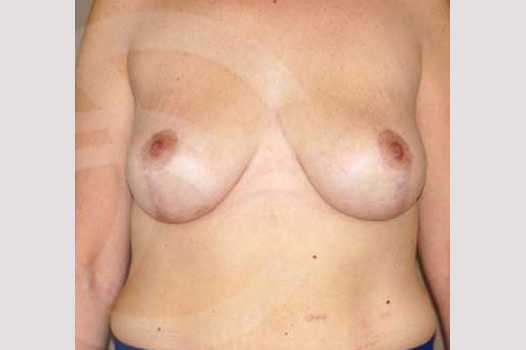 Breast Lift Inverse-T Scar ante/post-op I