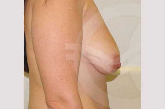 Breast Lift Inverse-T Scar ante/post-op III