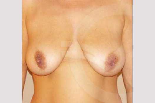 Breast Lift Uplift with 335cc Anatomic Implants ante/post-op I