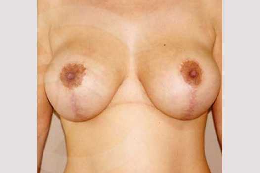 Breast Lift Uplift with 335cc Anatomic Implants ante/post-op I