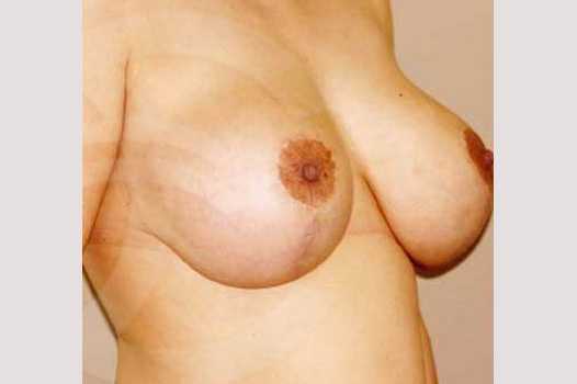 Breast Lift Uplift with 335cc Anatomic Implants ante/post-op II