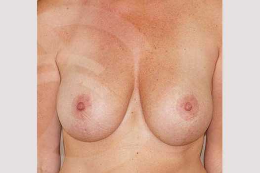 Bruststraffung Implantate und vertikaler Narbe ante/post-op I