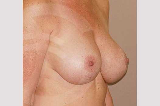Breast Lift Mastopexy with 350cc Implants ante/post-op II
