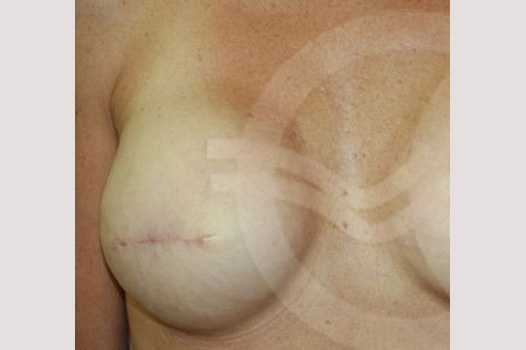 Breast Reconstruction AREOLAR PIGMENTATION ante/post-op I