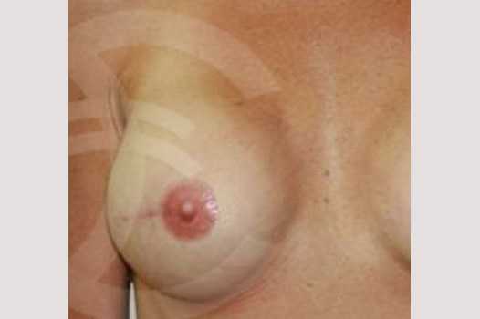 Breast Reconstruction AREOLAR PIGMENTATION ante/post-op I