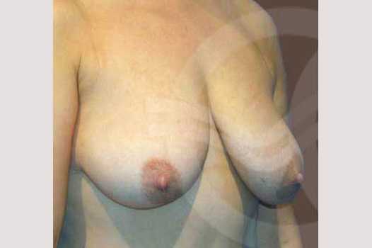 Breast Reconstruction BREAST TISSUE LOSS ante/post-op I