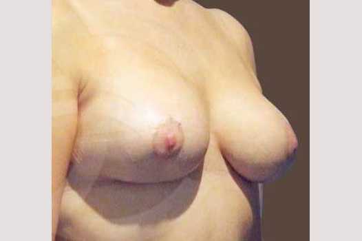 Breast Reconstruction BREAST TISSUE LOSS ante/post-op I