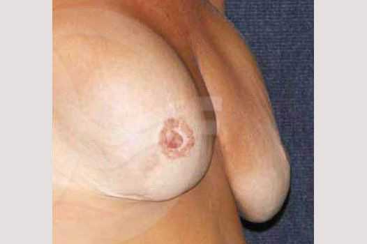 Breast Reconstruction AFTER BREAST REDUCTION ante/post-op I