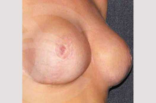 Breast Reconstruction AFTER BREAST REDUCTION ante/post-op II