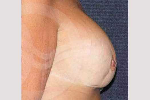 Breast Reconstruction AFTER BREAST REDUCTION ante/post-op III