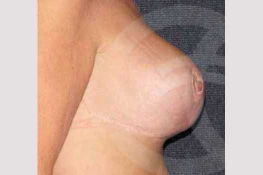 Breast Reconstruction AFTER BREAST REDUCTION ante/post-op III