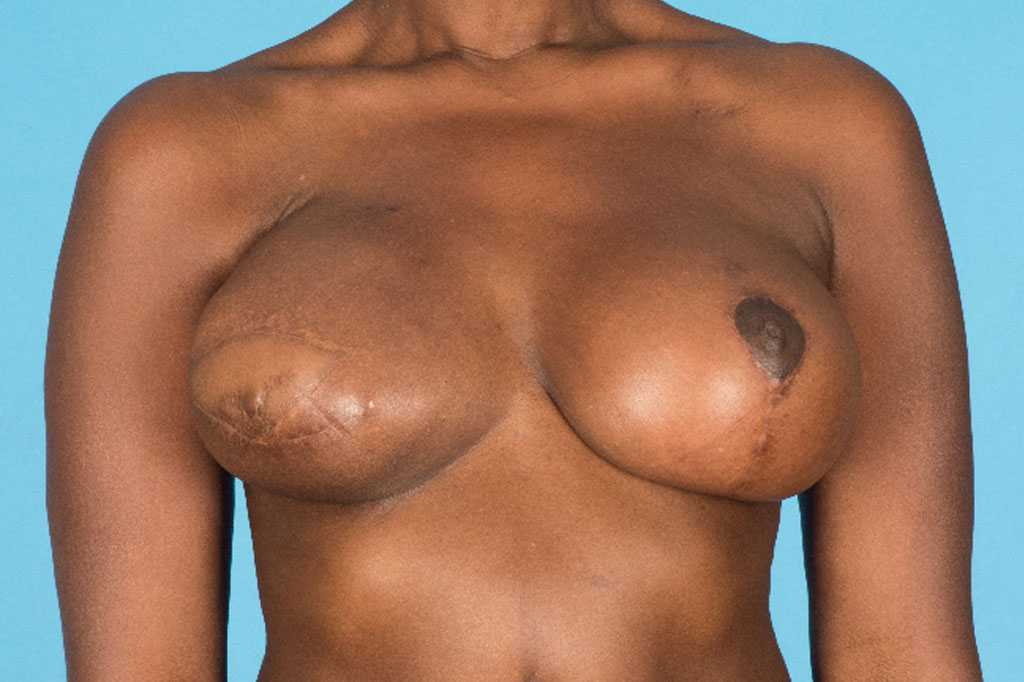 Photos Breast Reconstruction  ante/post-op I