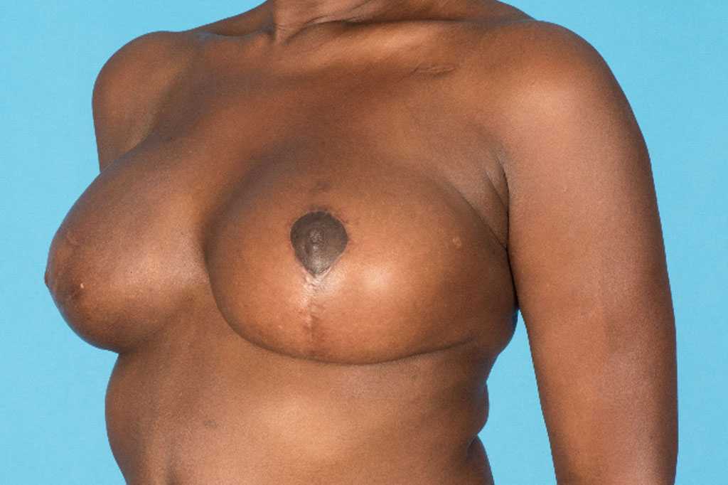 Photos Breast Reconstruction  ante/post-op III