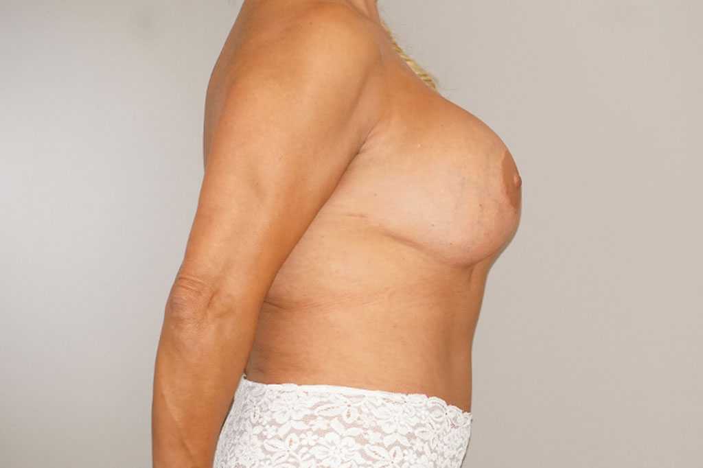 Breast Reconstruction Breast with indentation ante/post-op III