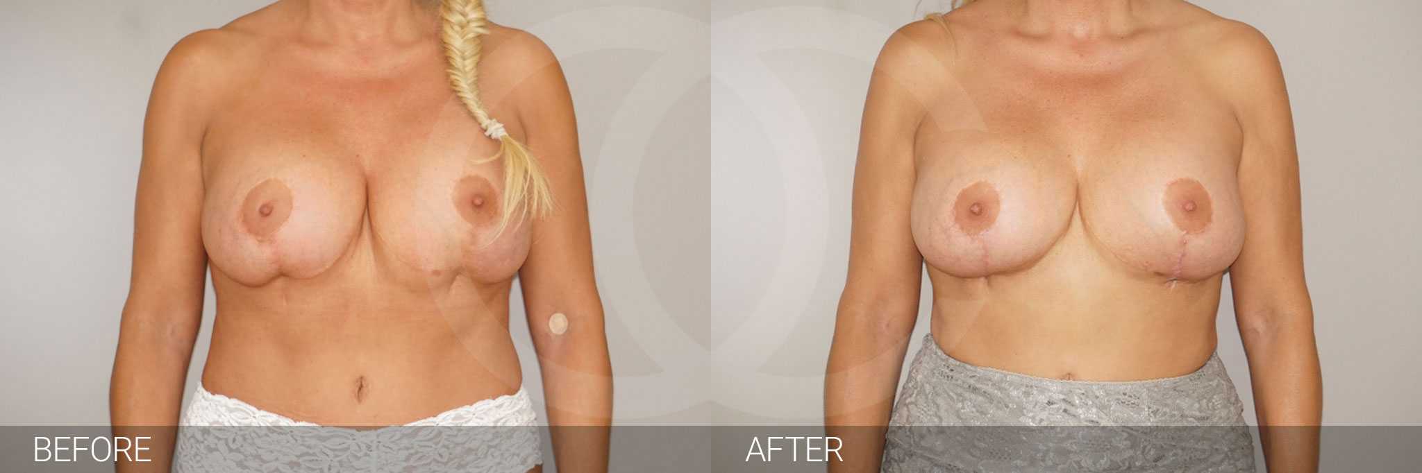 Breast Reconstruction Breast with indentation ante/post-op I