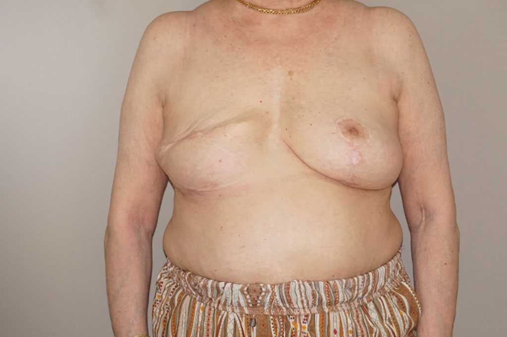 Breast Reconstruction after breast cancer ante/post-op I