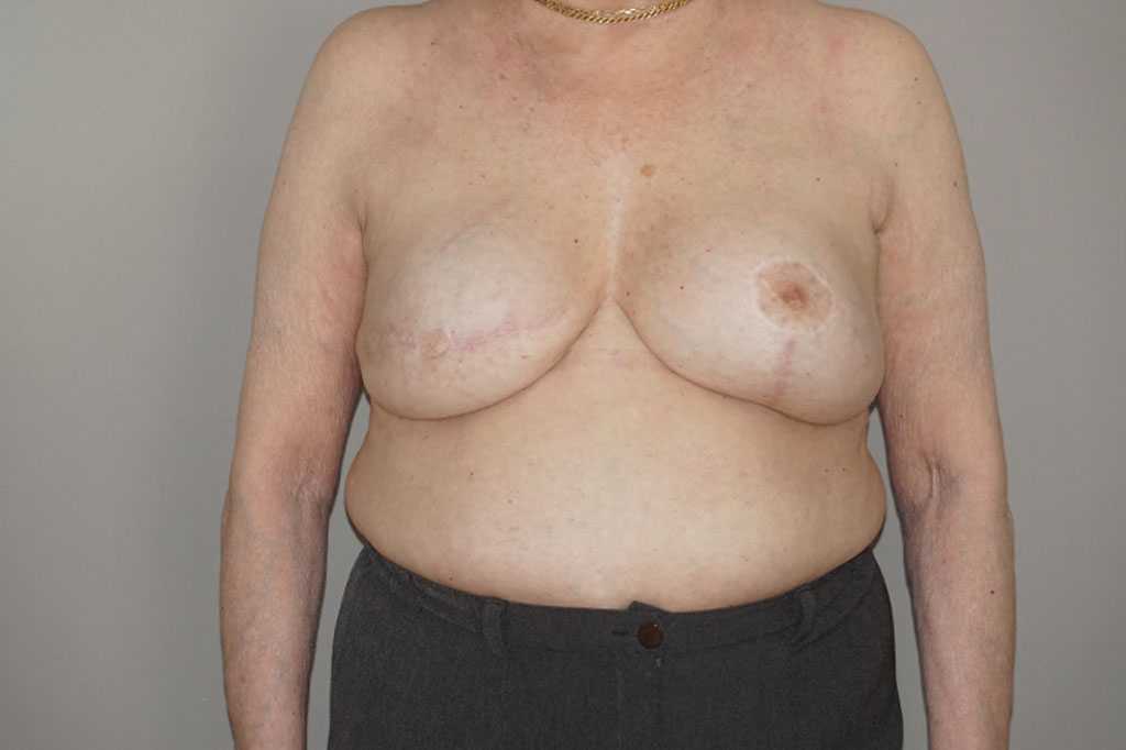 Breast Reconstruction after breast cancer ante/post-op I