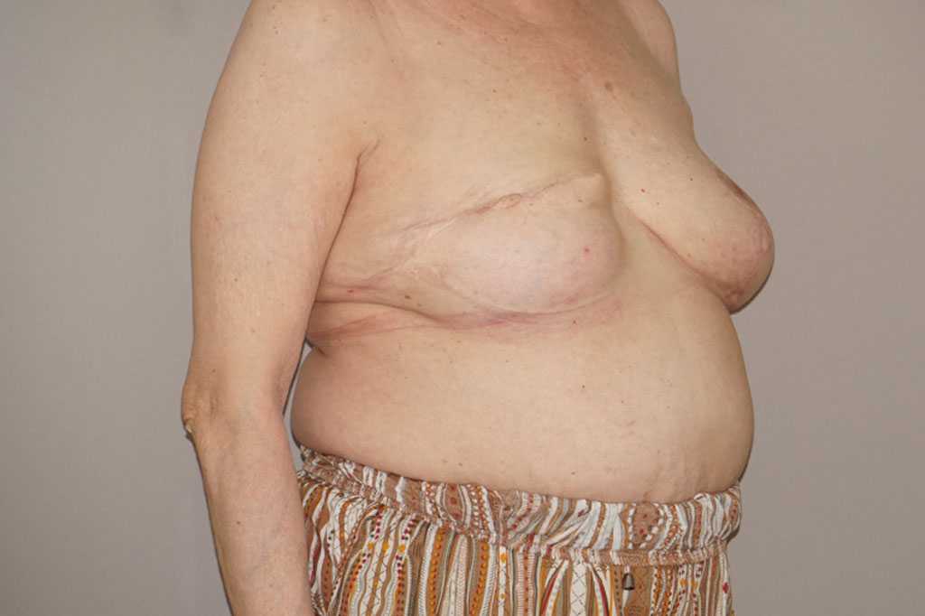 Breast Reconstruction after breast cancer ante/post-op II