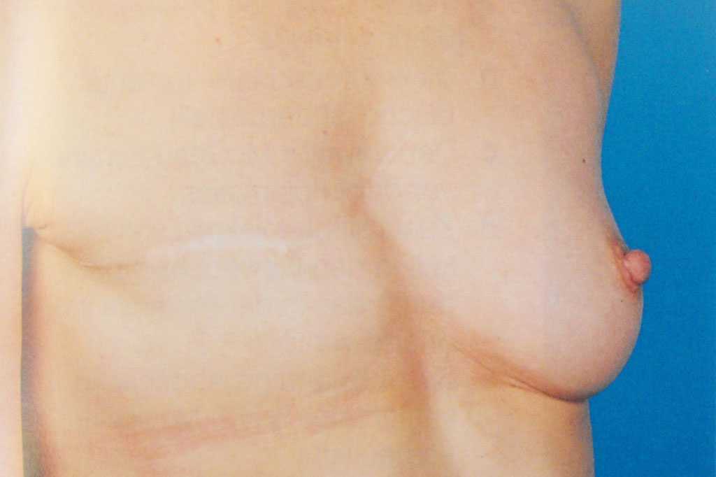 Breast Reconstruction after mastectomy ante/post-op II