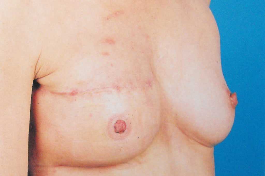 Breast Reconstruction after mastectomy ante/post-op II