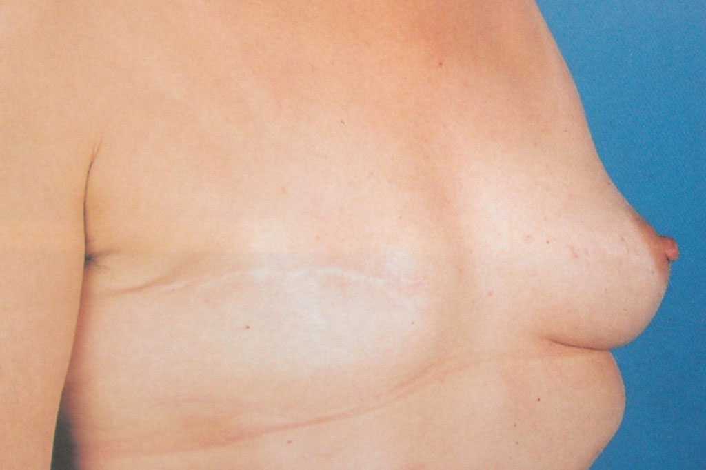 Breast Reconstruction after mastectomy ante/post-op III