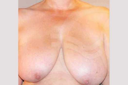 Breast Reduction BREAST LIPOSUCTION ante/post-op I