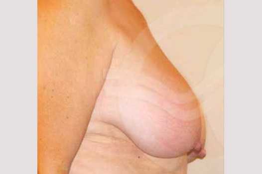 Breast Reduction BREAST LIPOSUCTION ante/post-op III