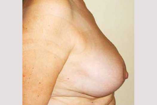 Breast Reduction BREAST LIPOSUCTION ante/post-op III