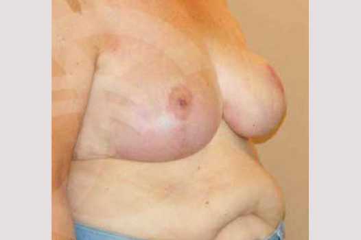 Breast Reduction VOLUME REDUCTION ante/post-op II