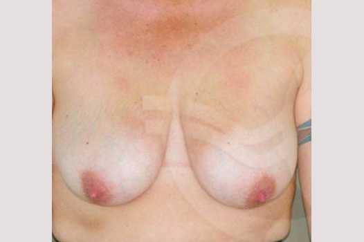 Reducción de pechos Mamoplastia de Reducción ante/post-op I