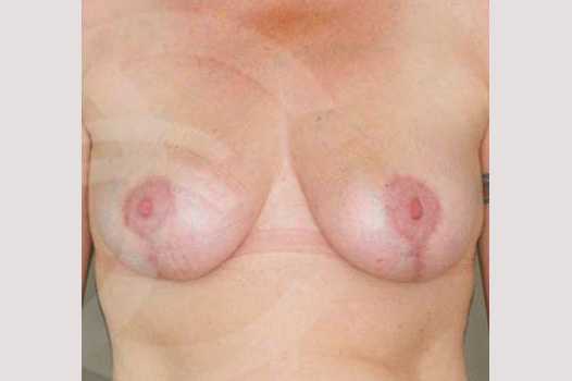 Reducción de pechos Mamoplastia de Reducción ante/post-op I