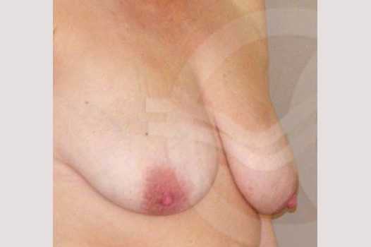 Reducción de pechos Mamoplastia de Reducción ante/post-op II