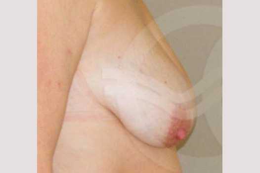Reducción de pechos Mamoplastia de Reducción ante/post-op III