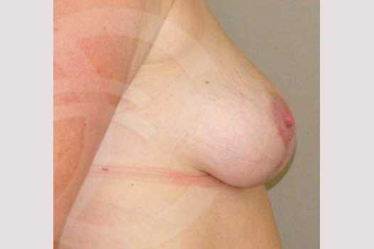 Breast Reduction REDUCTION MAMMOPLASTY ante/post-op III