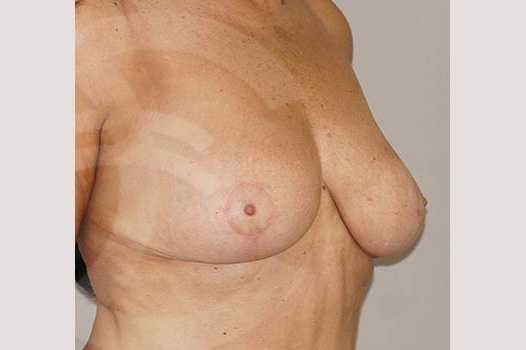 Breast Reduction REDUCTION MAMMOPLASTY ante/post-op II