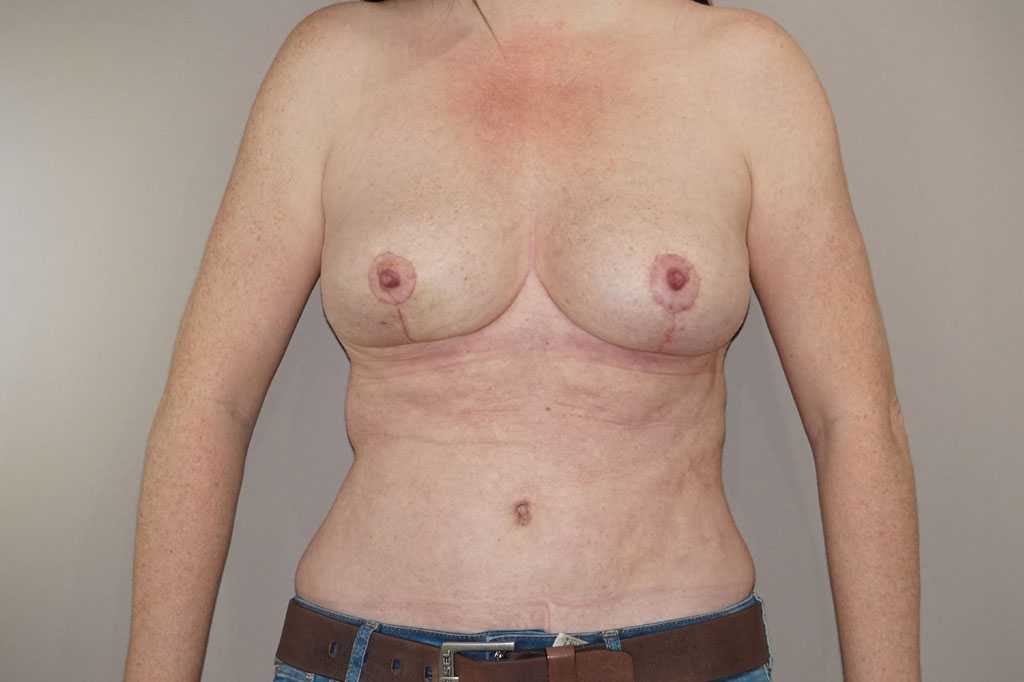 Breast Reduction Inverted-T-scar ante/post-op I