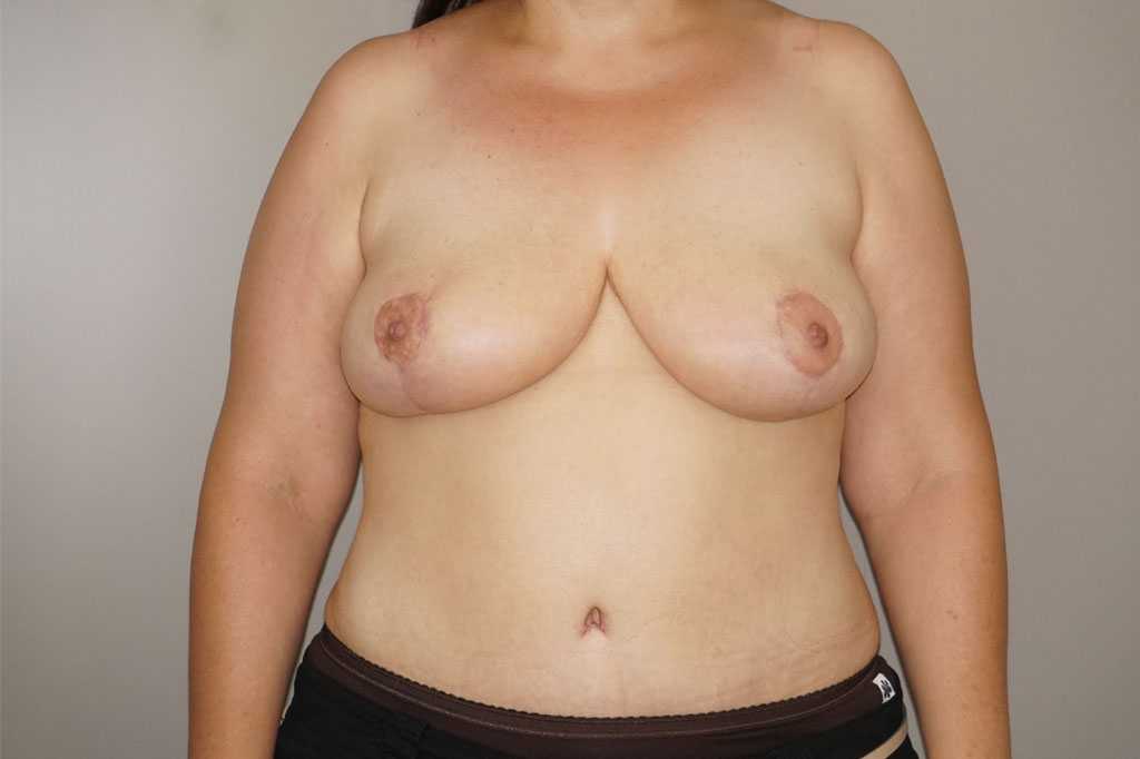 Breast Reduction in combination post-op profil