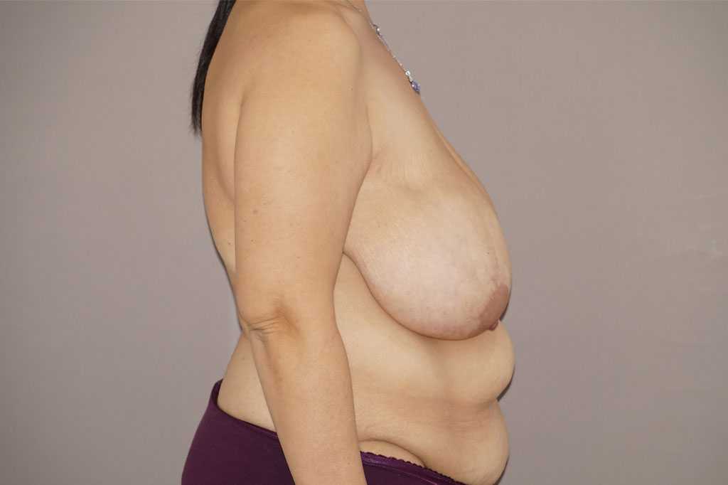 Réduction mammaire 2 ante-op retro/lateral
