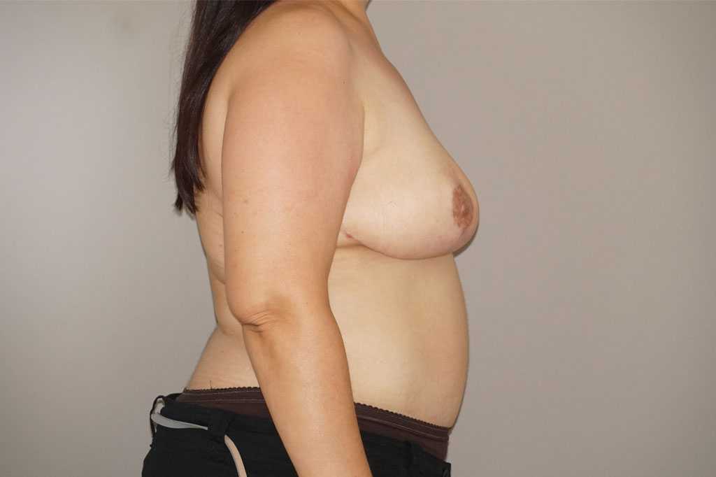 Breast Reduction in combination ante/post-op III