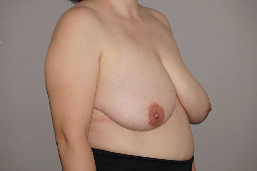 Breast Reduction with liposuction ante/post-op II