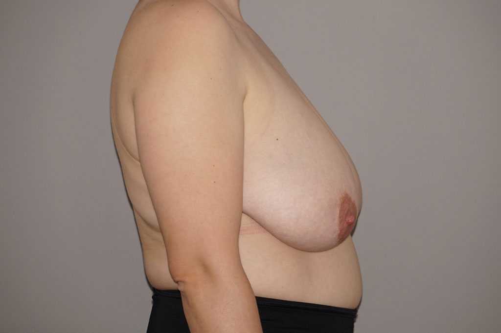 Breast Reduction with liposuction ante/post-op III