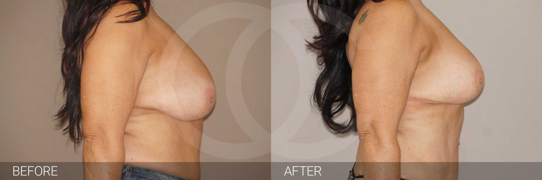 Breast Reduction REDUCTION MAMMOPLASTY ante/post-op III