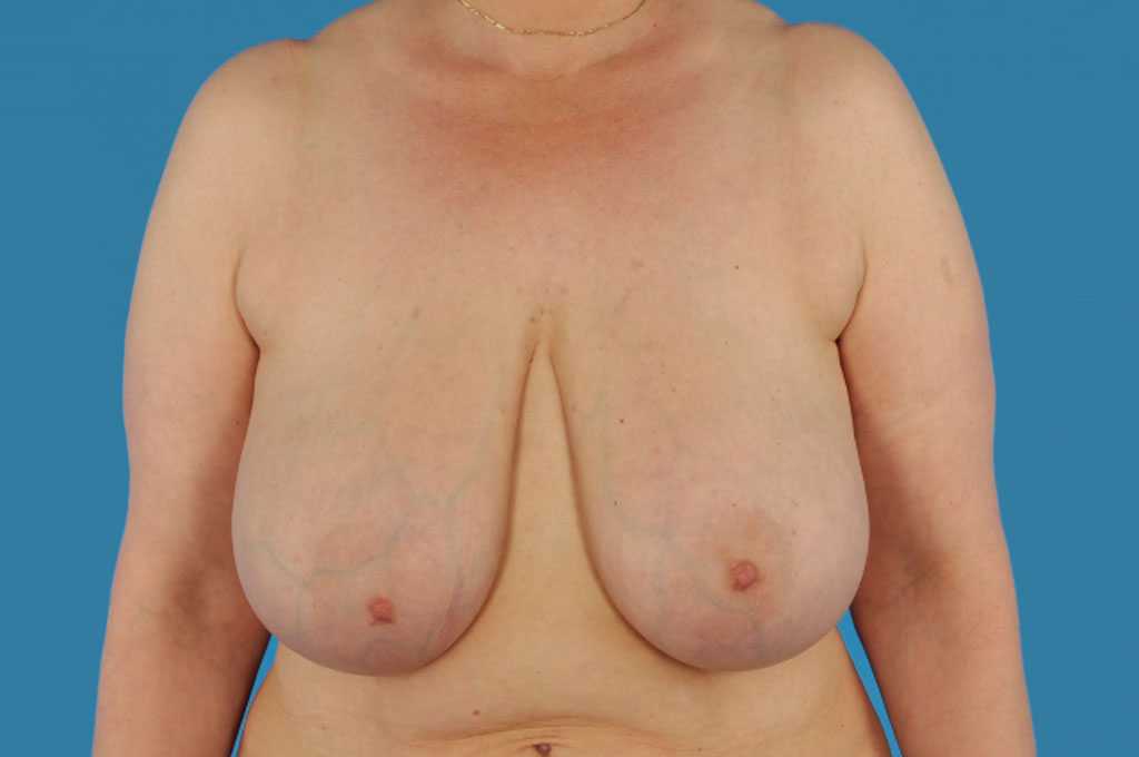 Réduction mammaire 5 ante-op profil