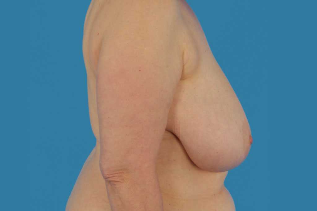 Breast Reduction Hall-Findlay ante/post-op III